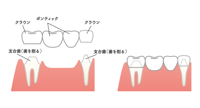 入れ歯イメージ画像